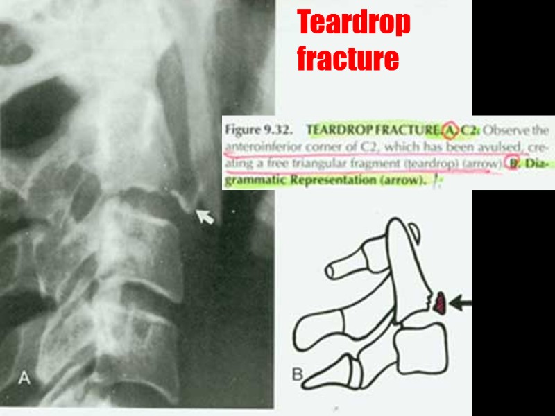 Teardrop fracture